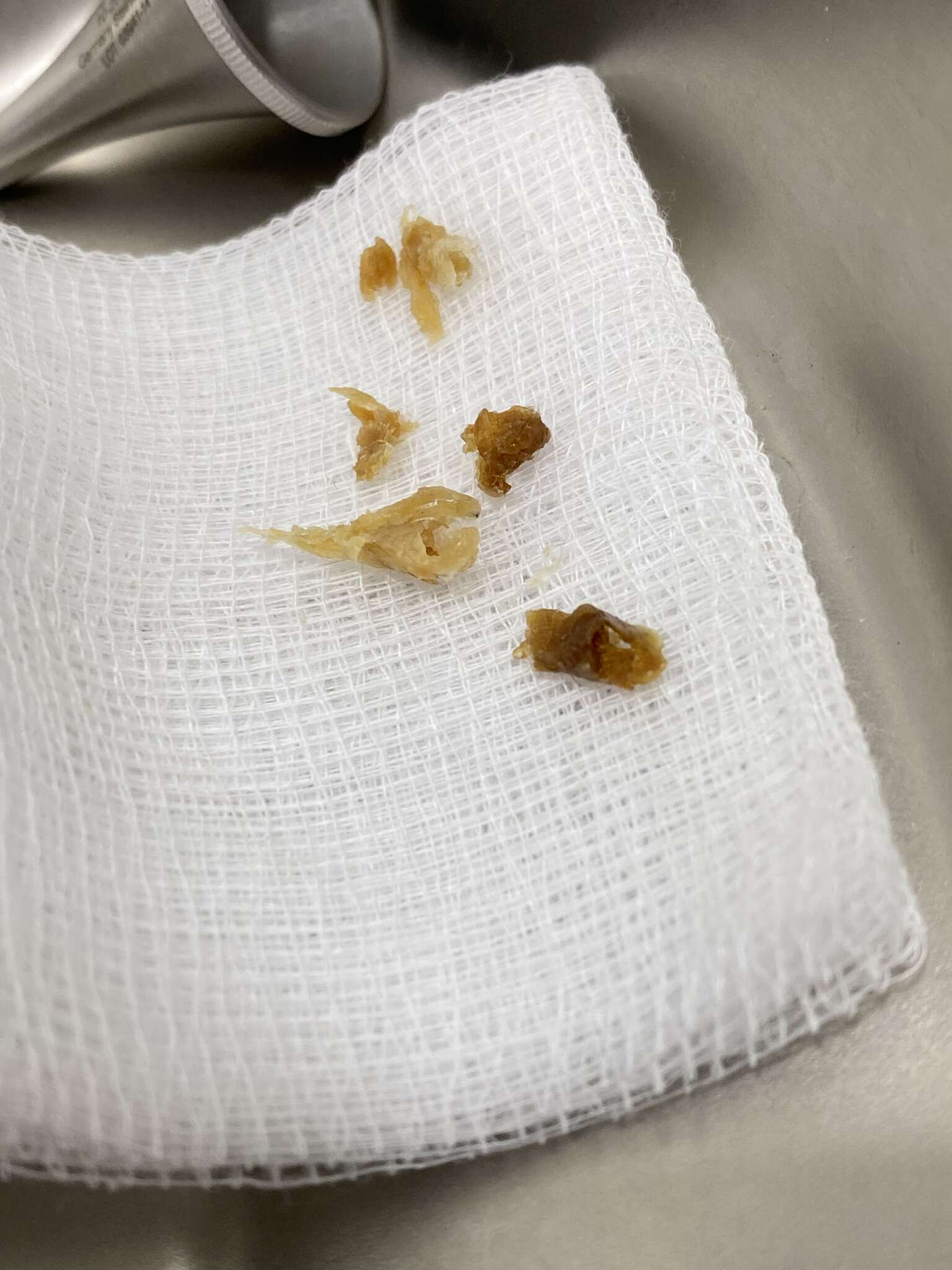 Ear Wax Removal Singapore Professional Ear Cleaning & Earwax Extractions